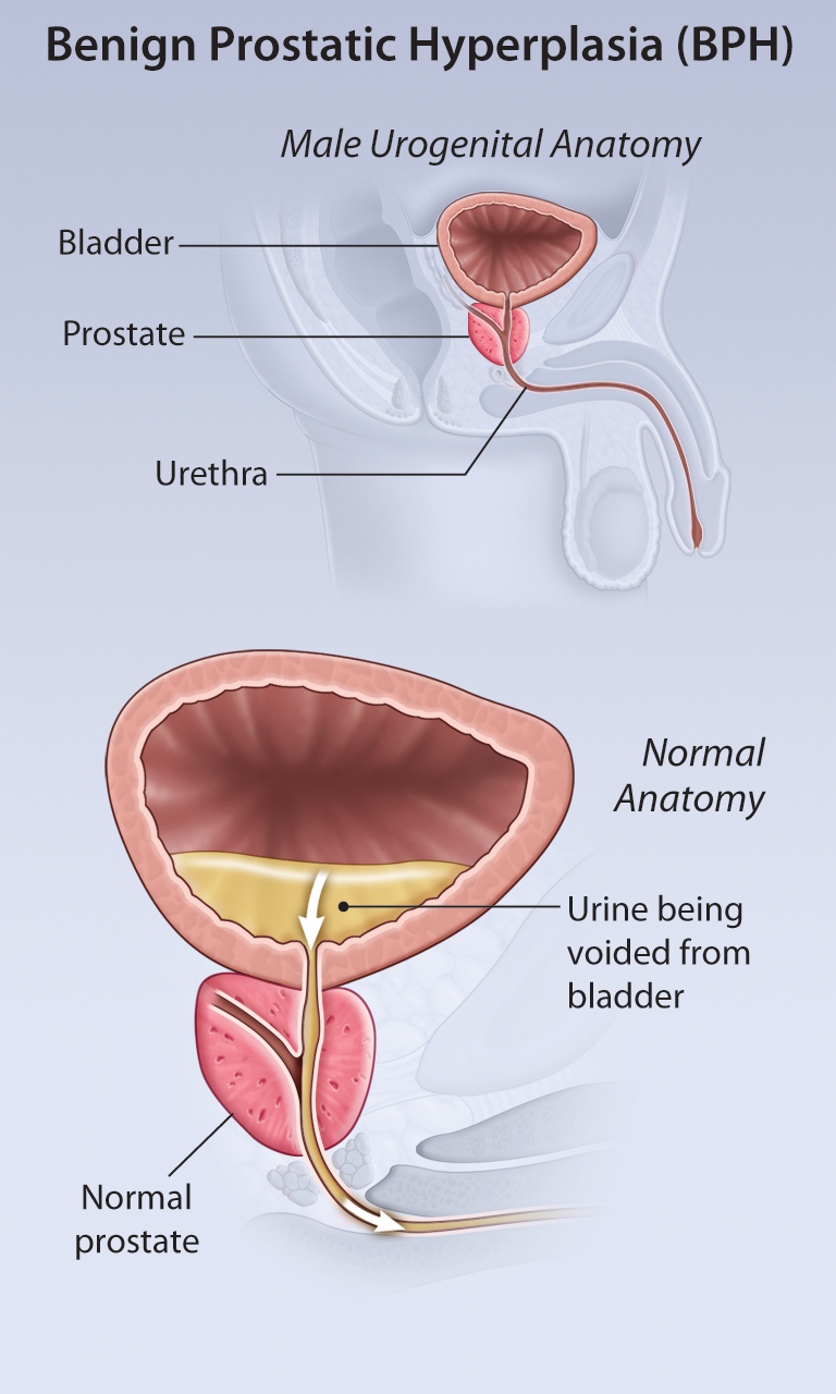 clonidine benign prostatic hyperplasia