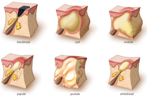 pimple microscope