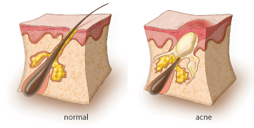 pimple microscope