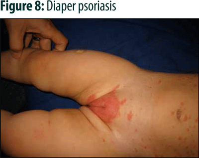 Genital Rash Child