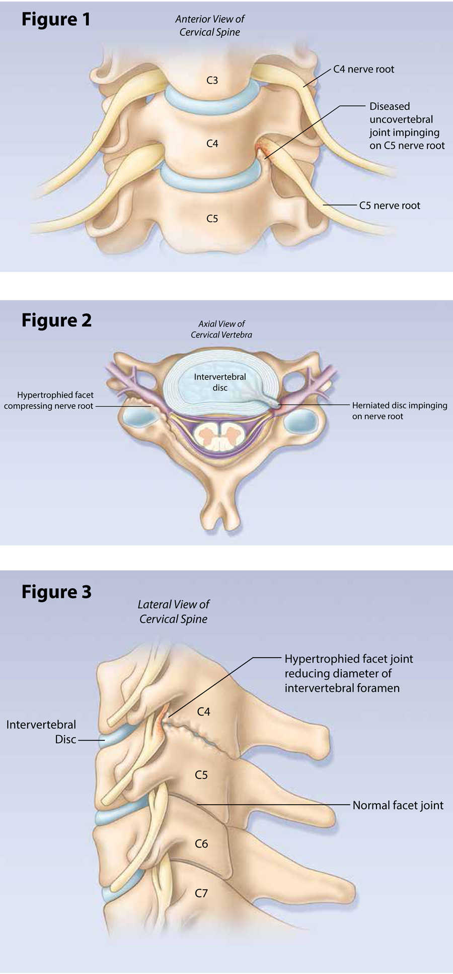 Cervical Radiculopathy: Diagnosis and Management | HealthPlexus.net