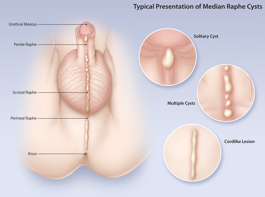 Pathology of Median Raphe Cyst - Dr Sampurna Roy MD