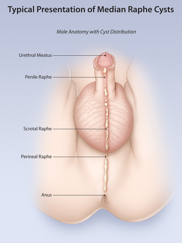 Cyst of anus