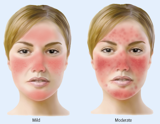 About Rosacea Healthplexus Net