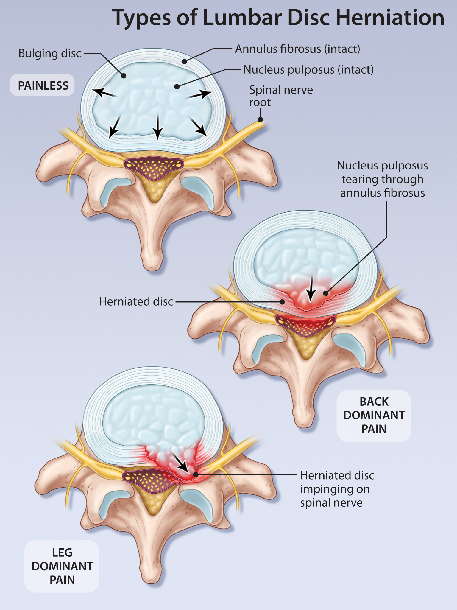 Current Management Of Symptomatic Lumbar Disc Herniation