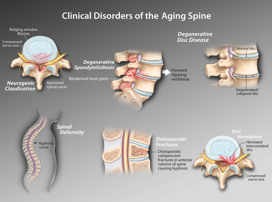 An Overview Of Lumbar Degenerative Disc Disease - vrogue.co