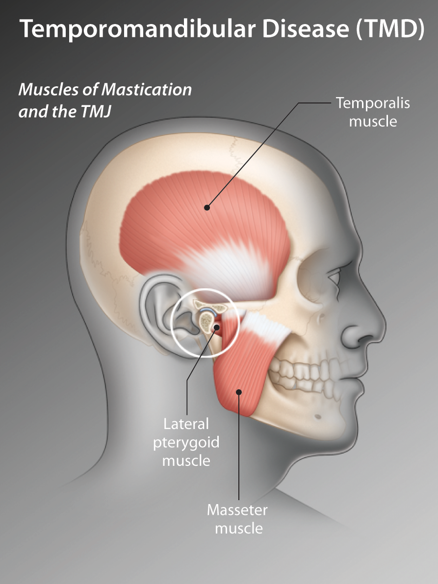 Temporomandibular Joint Disorders - Pictures