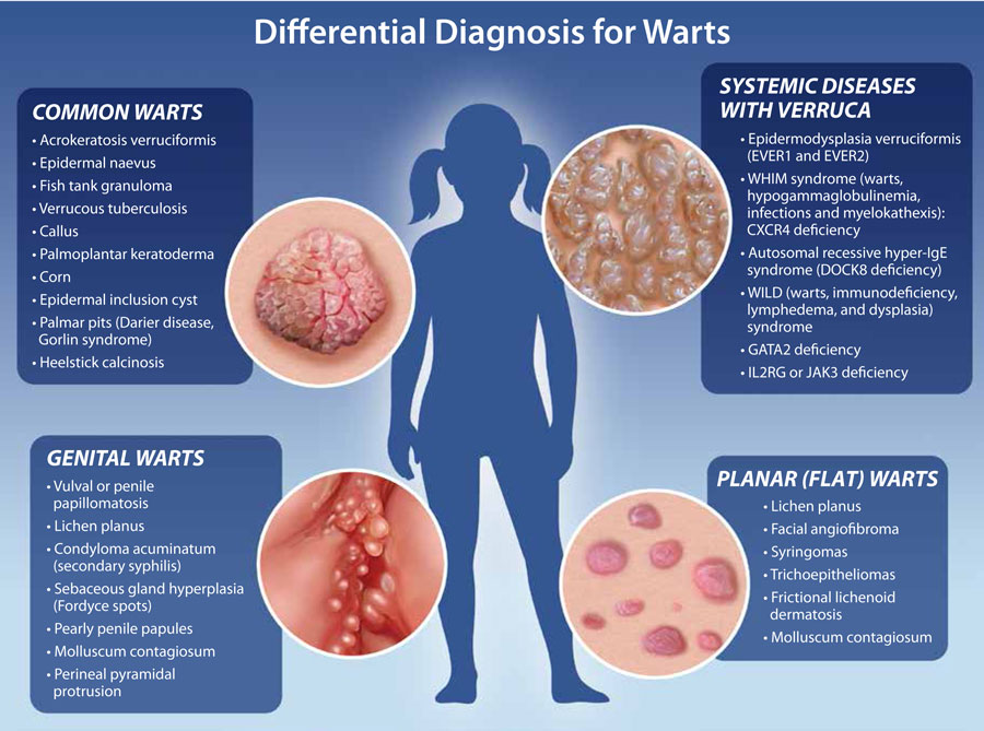 Pediatric Warts 2023 Update HealthPlexus