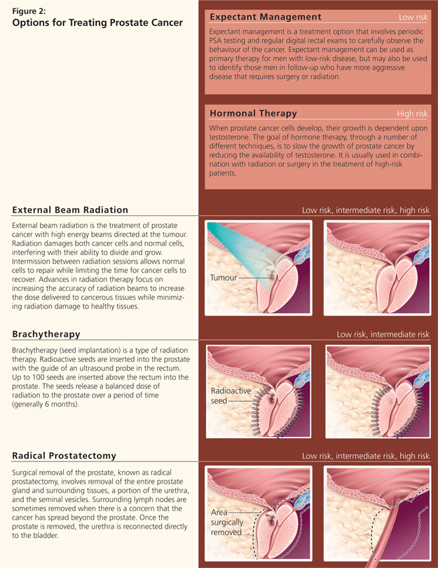 Types Of Prostate Cancer Radiation Treatment Options