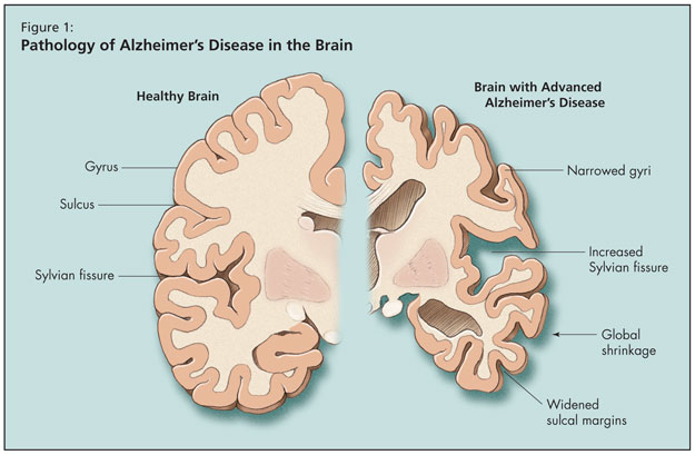 Senile Degeneration Of The Brain