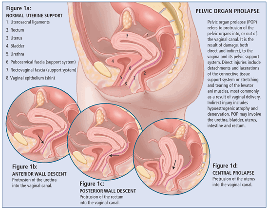 Pelvic Organ Prolapse