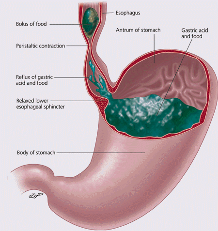 Gerd Body System Acid Reflux Body Diagram
