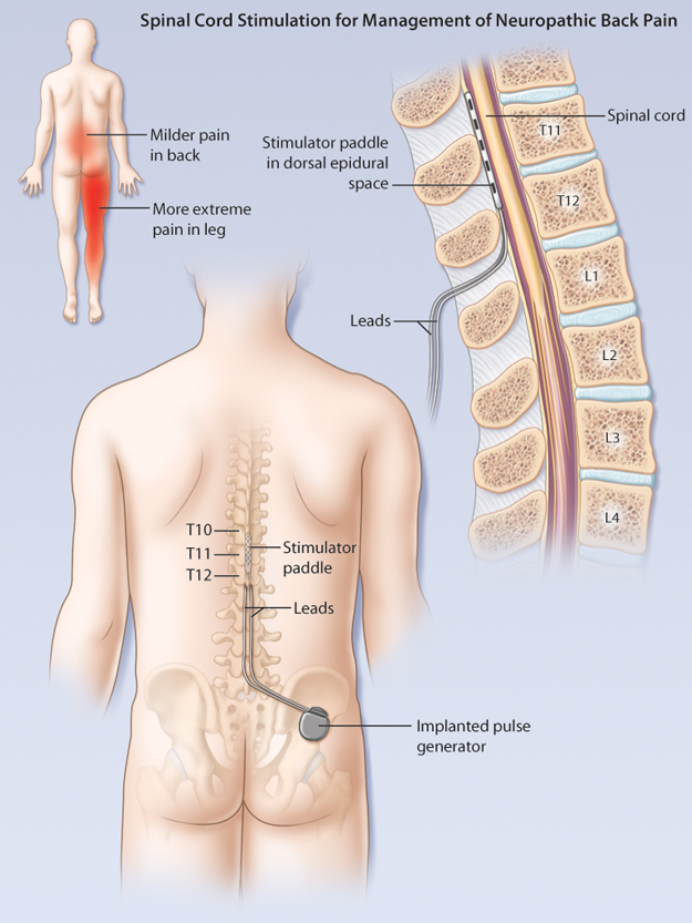 Oracle Pain Clinic - Spinal Cord Stimulation