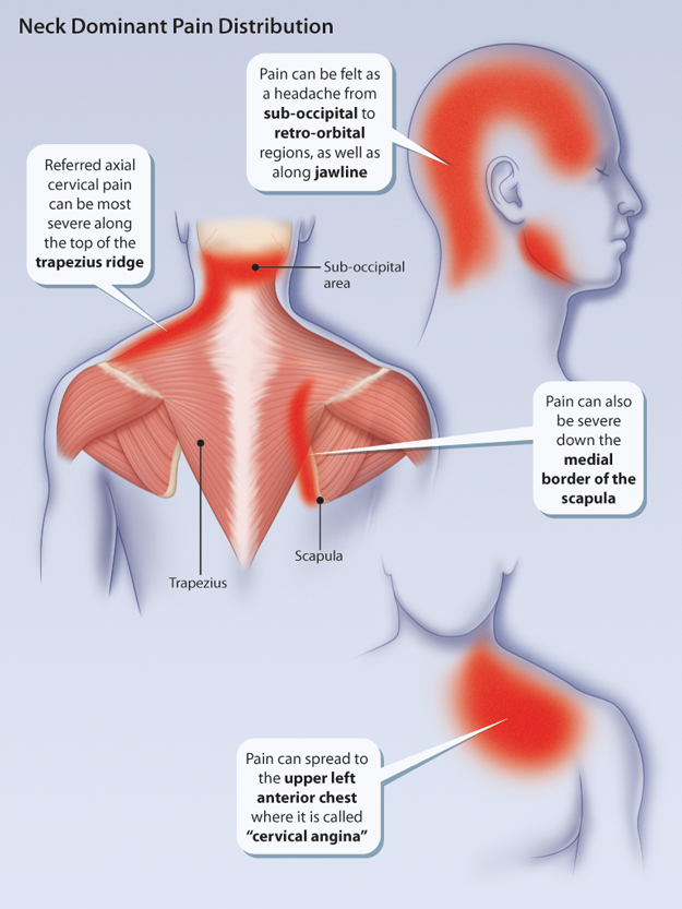 A Pain In The Neck HealthPlexus