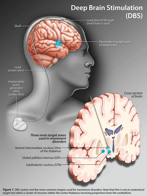 deep brain stimulation action potential